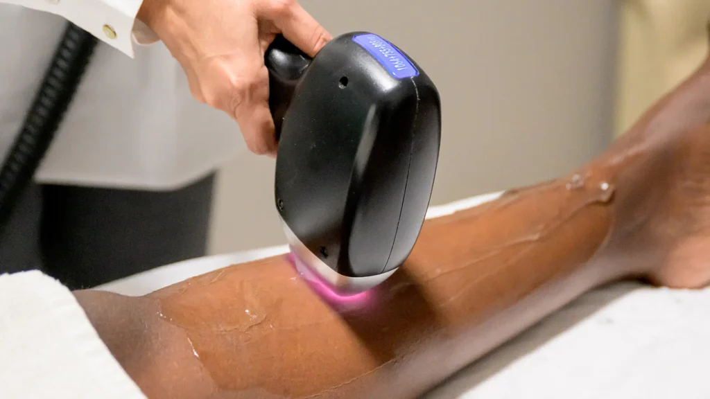 Advanced Laser Hair Removal treatment at Enrich by Naseema in Lusaka